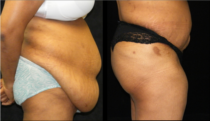 POST-WEIGHT LOSS SURGERY BODY CONTOURING