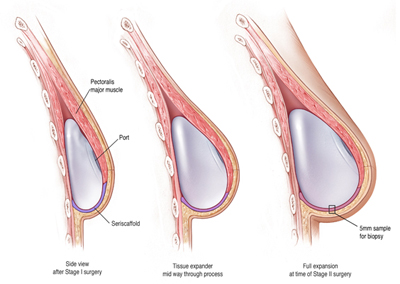 BREAST IMPLANT REVISION