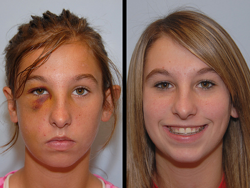 FACIAL TRAUMA