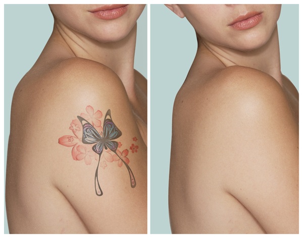 Tattoo Removal 
