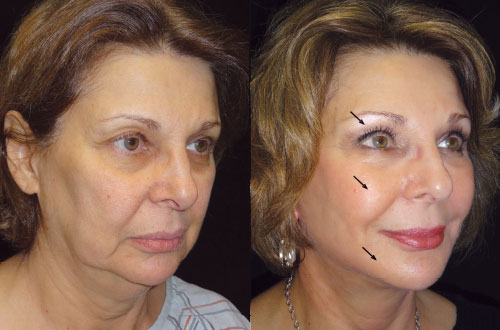Facial Fat Transfer