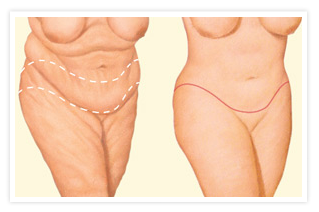 POST-WEIGHT LOSS SURGERY BODY CONTOURING