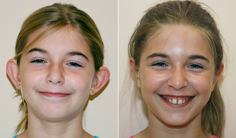 (Ear Contouring (otoplasty