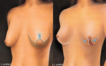Breast Lift (Mastopexy)
