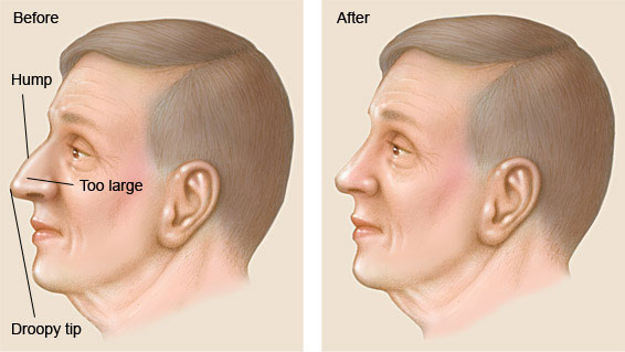 Male Rhinoplasty
